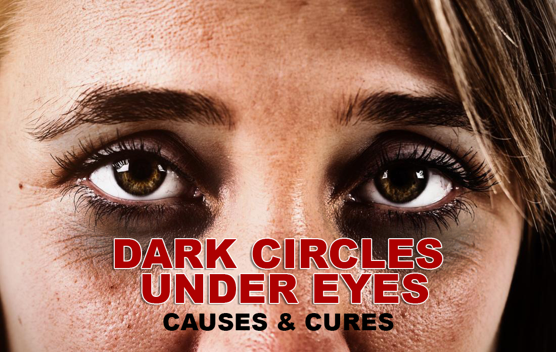 How to get rid of dark circles under your eyes